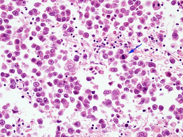 1C4 Germinoma (Case 1) H&E 1 copy