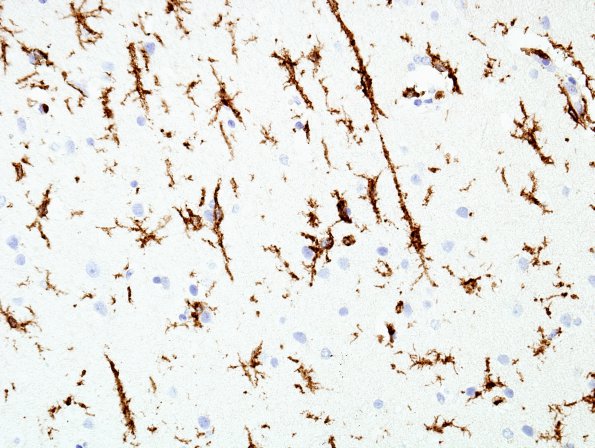 1F2 Germinoma (Case 1) CD45