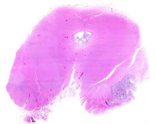 1J Germinoma (Case 1)