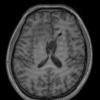 2A2 Germinoma, callosum (Case 2) T1 3 - Copy