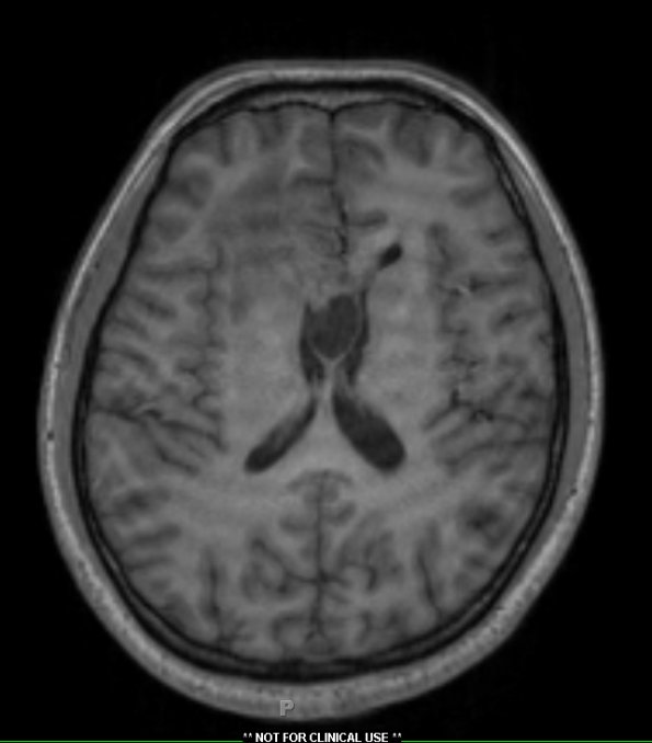 2A2 Germinoma, callosum (Case 2) T1 3 - Copy