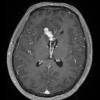 2A3 Germinoma, callosum (Case 2) T1W1 - Copy