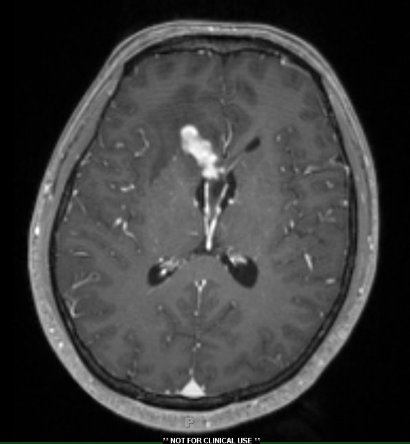 2A3 Germinoma, callosum (Case 2) T1W1 - Copy