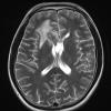 2A4 Germinoma, callosum (Case 2) T2 - Copy