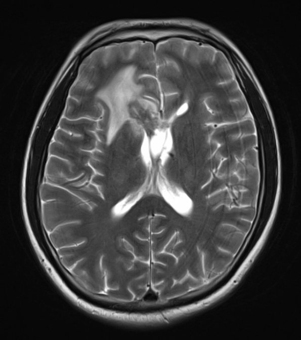 2A4 Germinoma, callosum (Case 2) T2 - Copy