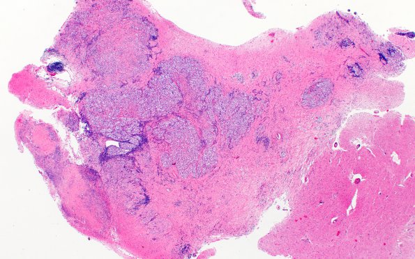 2B2 Germinoma, callosum (Case 2) H&E 11