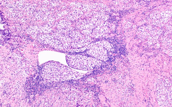 2B3 Germinoma, callosum (Case 2) H&E 4