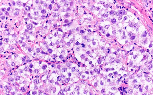 2B4 Germinoma, callosum (Case 2) H&E 6