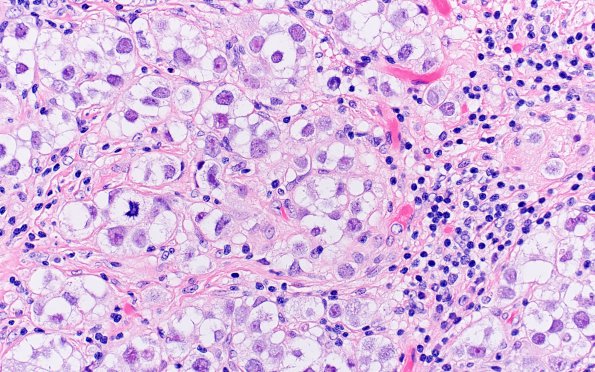 2B5 Germinoma, callosum (Case 2) H&E 9