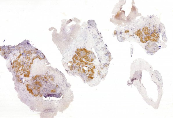 2D1 Germinoma, callosum (Case 2) OCT3-4 WM