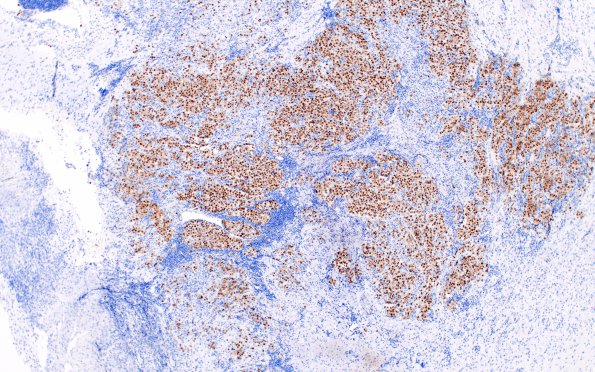 2D2 Germinoma, callosum (Case 2) OCT 3-4 1