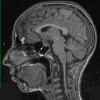 3A1 Germinoma (Case 3) T1 1 copy - Copy