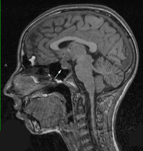 3A1 Germinoma (Case 3) T1 1 copy - Copy