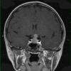 3A2 Germinoma (Case 3) T1 W 1 - Copy