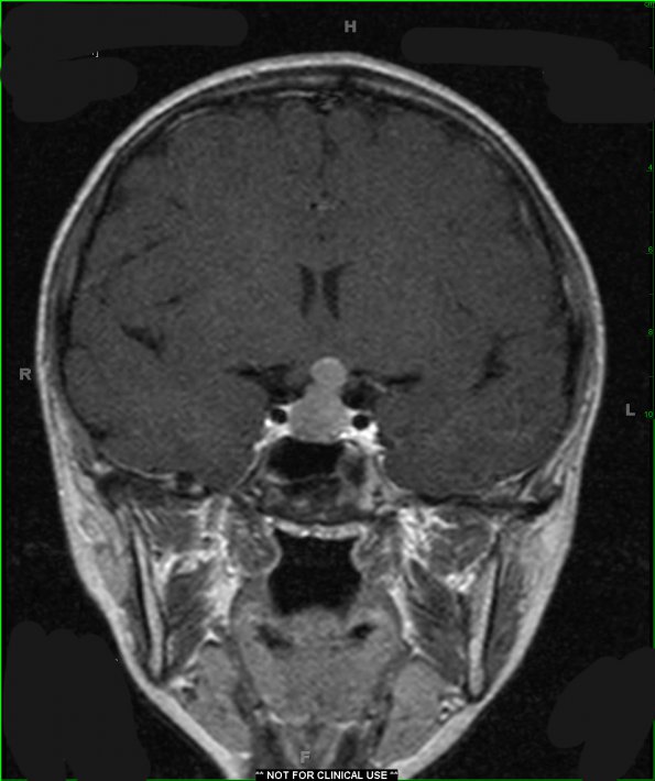 3A2 Germinoma (Case 3) T1 W 1 - Copy