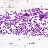 3B1 Germinoma (Case 3) Smear 1