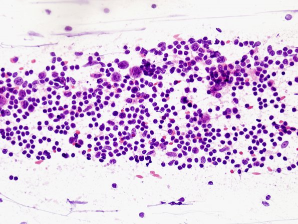 3B1 Germinoma (Case 3) Smear 1