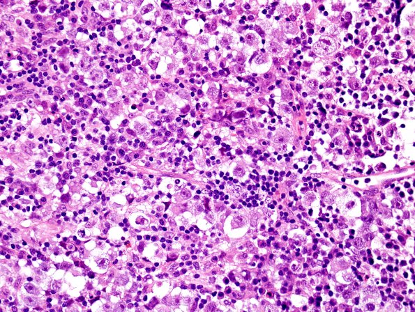 3B2 Germinoma (Case 3) H&E 2