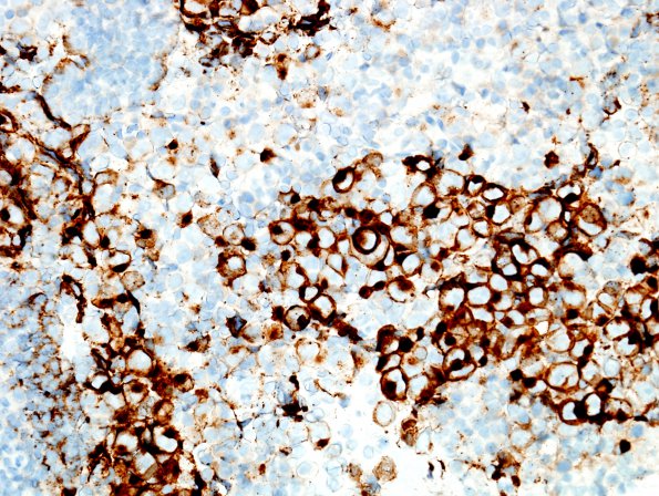 3C1 Germinoma (Case 3) PLAP 1