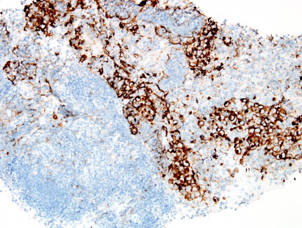 3C2 Germinoma (Case 3) PLAP 2