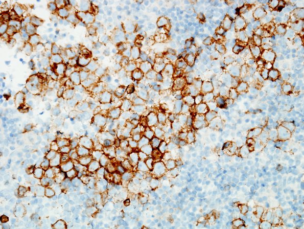 3E1 Germinoma (Case 3) c-kit 1