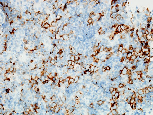 3E2 Germinoma (Case 3) c-kit 3