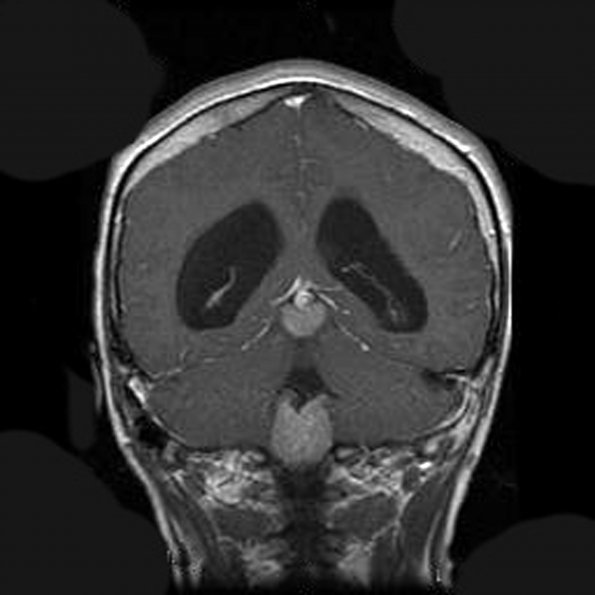 4A2 Germinoma (Case 4) T1W - Copy