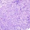 4B1 Germinoma (Case 4) granulomatous reaction 8