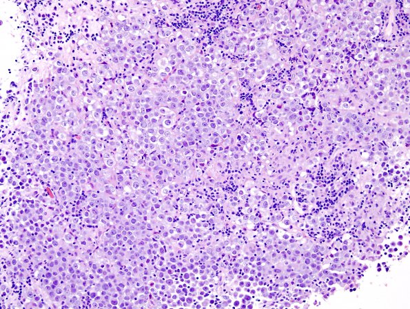 4B1 Germinoma (Case 4) granulomatous reaction 8