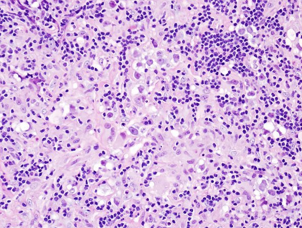 4B2 Germinoma (Case 4) granulomatous reaction 4
