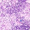 4B3 Germinoma (Case 4) granulomatous reaction 2 copy