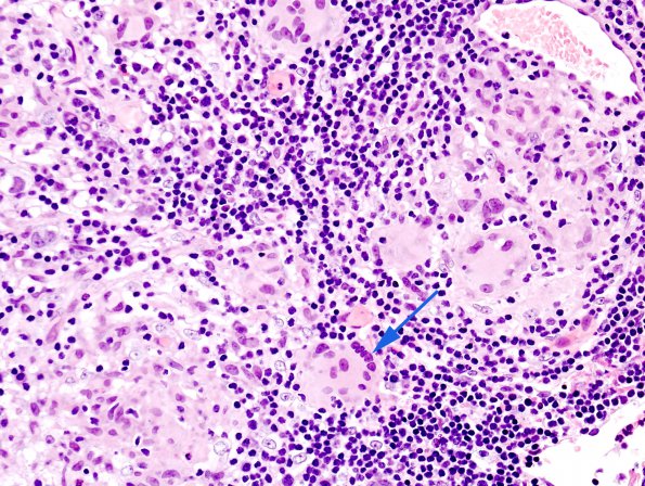 4B3 Germinoma (Case 4) granulomatous reaction 2 copy