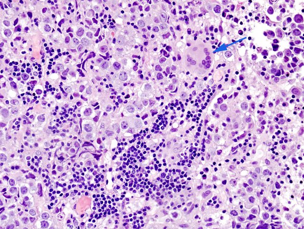 4B4 Germinoma (Case 4) granulomatous reaction 7