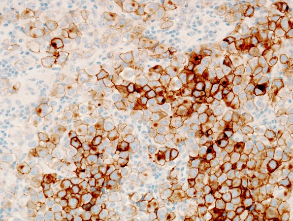 4C Germinoma (Case 4) PLAP 1