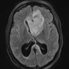 5A1 Germinoma (Case 5) TRA FLAIR 1 - Copy