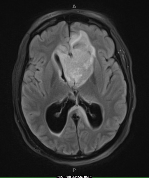 5A1 Germinoma (Case 5) TRA FLAIR 1 - Copy