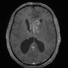 5A2 Germinoma (Case 5) T1W 1 - Copy