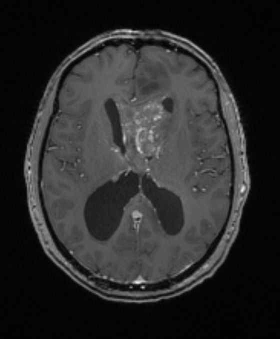 5A2 Germinoma (Case 5) T1W 1 - Copy