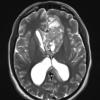 5A3 Germinoma (Case 5) T2W 1 - Copy