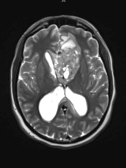 5A3 Germinoma (Case 5) T2W 1 - Copy