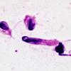 5B1 Germinoma, intraventricular (Case 5) H&E smear 1.jpg