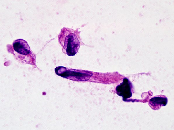 5B1 Germinoma, intraventricular (Case 5) H&E smear 1.jpg