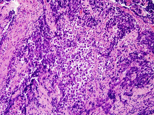 5B4 Germinoma, intraventricular (Case 5) H&E 1.jpg