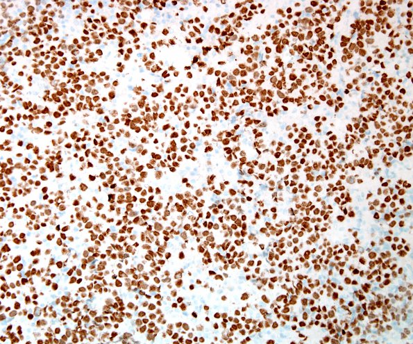 5D Germinoma, intraventricular (Case 5) SALL4 3.jpg