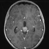 7A1 Germinoma, suprasellar & pineal (Case 7) T1  W 1 - Copy