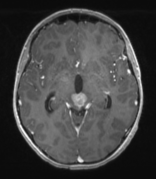 7A1 Germinoma, suprasellar & pineal (Case 7) T1  W 1 - Copy