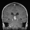 7A2 Germinoma, suprasellar & pineal (Case 7) T1 W 6 - Copy