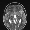 7A3 Germinoma, suprasellar & pineal (Case 7) T2 1 - Copy