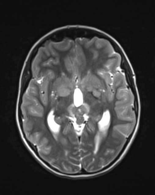 7A3 Germinoma, suprasellar & pineal (Case 7) T2 1 - Copy