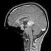 7A4 Germinoma, suprasellar & pineal (Case 7) - Copy